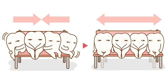 永久歯が生えてくるためのスペース作り