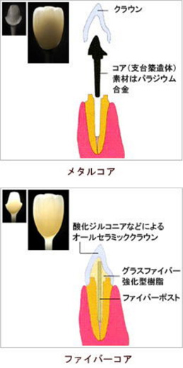 ファイバーコアとメタルコア
