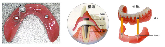 磁性アタッチメント(マグネット)