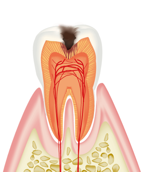 C2（象牙質の虫歯）