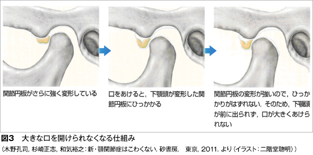 顎関節症はどんな状態になるのですか